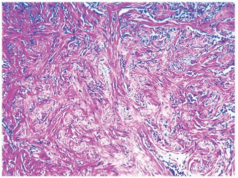Sclerosing Hemangioma Basicmedical Key