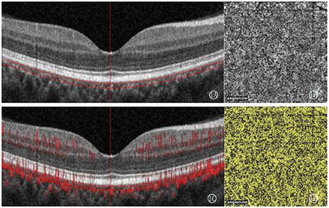 Frontiers Optical Coherence Tomography Angiography Predicts Visual