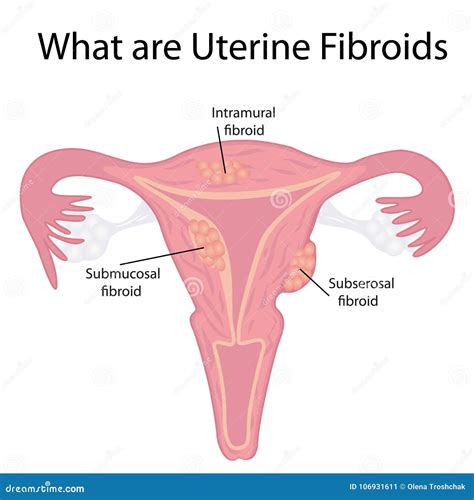 Types Of Uterine Fibroids Stock Vector Illustration Of Intramural