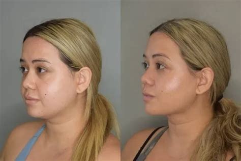 Chin Lipo Before And After The Anatomy Best Chin Lipo Results