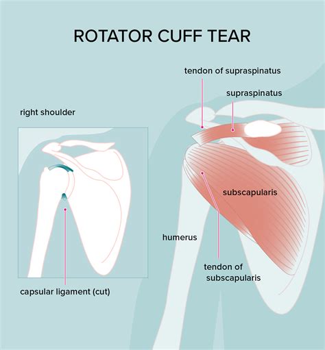 Rotator Cuff Tear Symptoms Pain