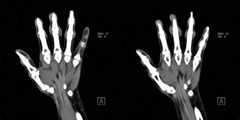 Computed Tomography Unenhanced Scanning The Right Hand Showing Soft