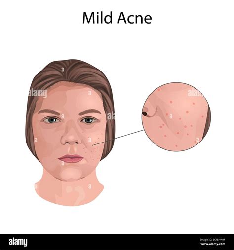 Moderate Acne Face