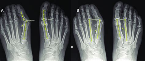 A Bilateral Standing Antero Posterior AP Radiographs Showing The