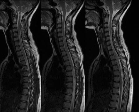 Neuroradiology Cases Cord Demyelination