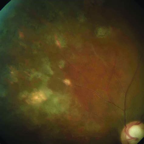 Fundus Image Of The Left Eye Showing Retinitis And Retinal Vasculitis