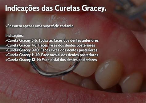 Indicações das Curetas Gracey e McCall Periodontia Resumo Concurso