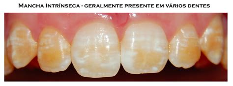 Aparelhos Ortod Nticos Mancham Os Dentes Porci Ncula Odontologia