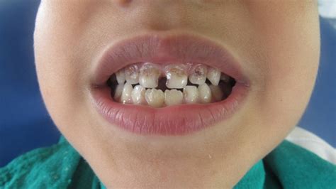 Tooth Decay in Children:The unanswered truth – Medchrome