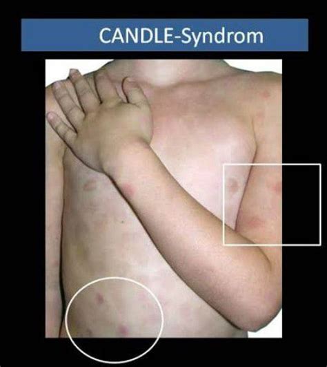 Candle Syndrome Medizzy