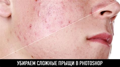 Убираем сложные прыщи в photoshop - YouTube