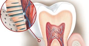 Hypersensibilité dentinaire