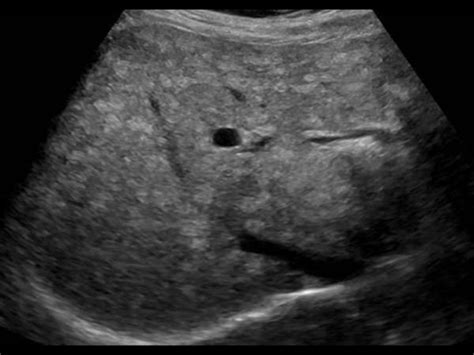 Abdomen And Retroperitoneum 1 1 Liver Case 1 1 11 Fatty Liver And