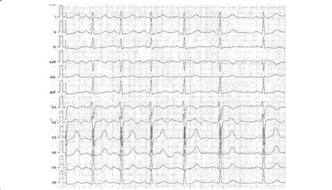 Resting 12 Lead Electrocardiogram Of The Described Patient Showing