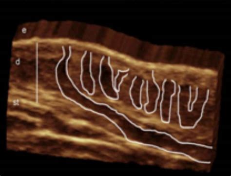 Hidradenitis Suppurativa Hs Disease Progression