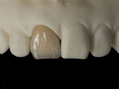 PFM Crowns | Modern Dental Laboratory Usa