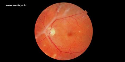 Retinal Detachment Symptoms Causes And Treatment Arohi Eye Hospital