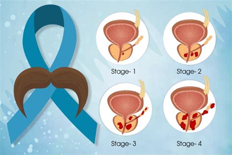 Prostate Cancer Stage 1