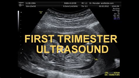 First Trimester Ultrasound Explained Easy With Pictures Youtube