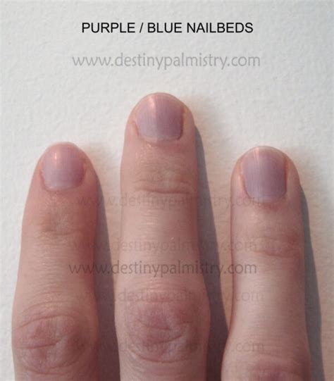 What Does Having Purple Nail Beds Mean At Timothy Sapp Blog