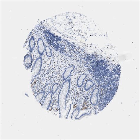 Tissue Expression Of Cd68 Staining In Colon The Human Protein Atlas