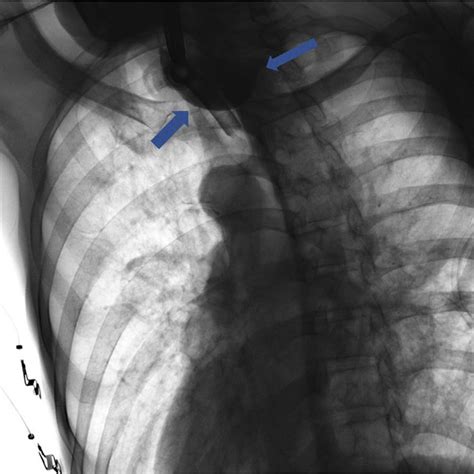 A EGD Image Of Esophageal Perforation After Savary Dilation B