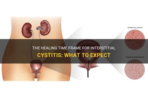 The Healing Time Frame For Interstitial Cystitis What To Expect Medshun