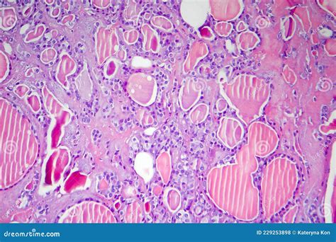 Follicular Adenoma Of Thyroid Gland Royalty Free Stock Photography