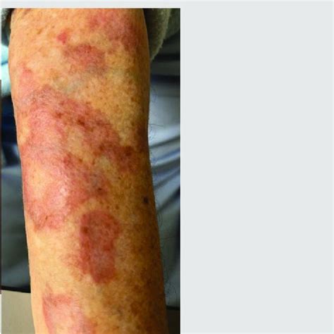 Erythematous Rash With Annular Discoloured Plaques In Both Forearms