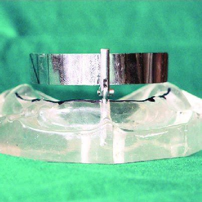 Paulo Malo guide used to place implants in the correct position ...