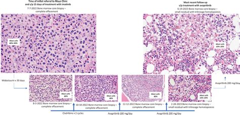 Sequential Bone Marrow Core Biopsies In A Patient Patient With Mast