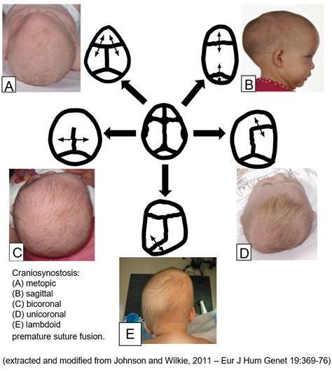 Craniosynostosis