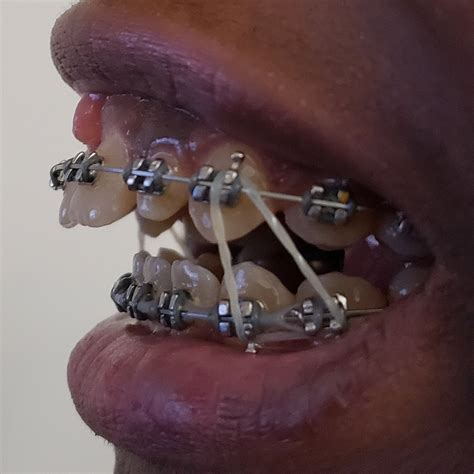 Top 99 Pictures Tool For Putting Rubber Bands On Braces Full Hd 2k 4k