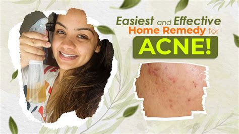 Easy Home Remedy For Acne Diy Just 3 Ingredients Skin Care Youtube