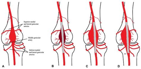 Symptomatic Type I Endoleak Following Popliteal Artery Aneurysm Repair