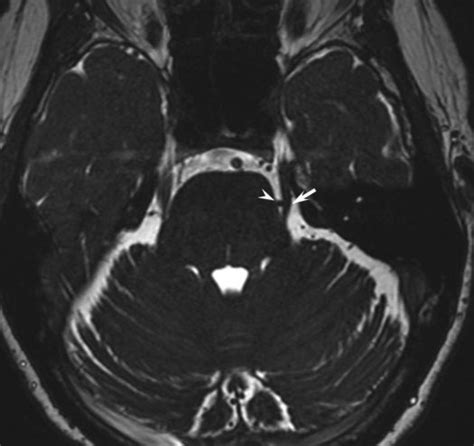 Retrosigmoid Approach For Glycerin Rhizotomy In The Treatment Of