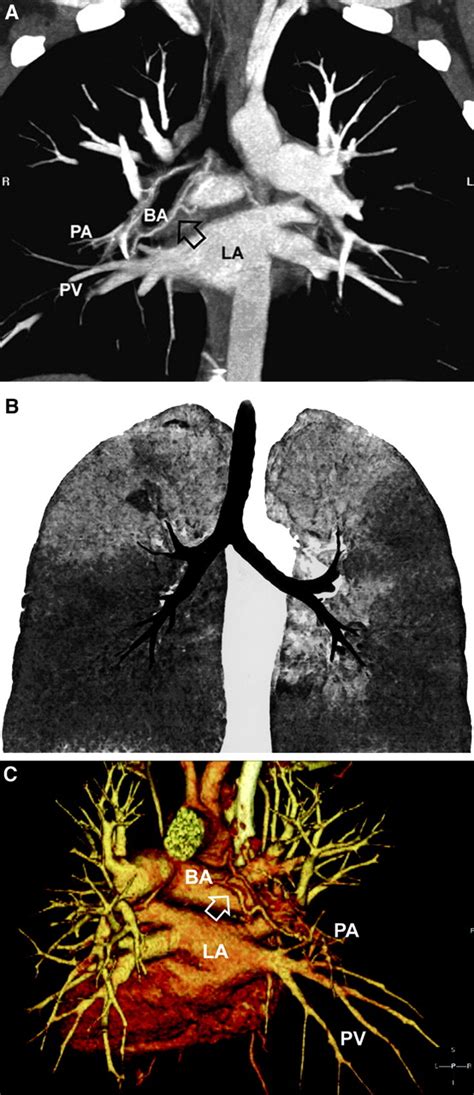 Spiral Computed Tomography For Acute Pulmonary Embolism Circulation