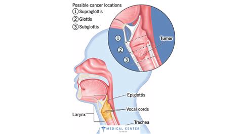 Laser Surgery For Laryngeal Cancer Mct