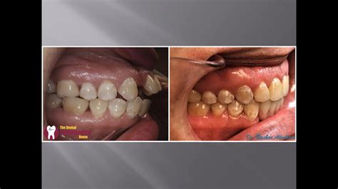 Check out this ortho transformation - YouTube