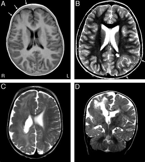 Magnetic Resonance Imaging Mri Of Focal Cortical Dysplasia Fcd And