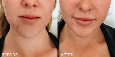 Microneedling For Glowing Skin — Lara Devgan Md Mph