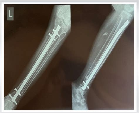 Post-operative left tibia. | Download Scientific Diagram