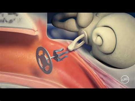 Kurz Passive Middle Ear Implants Tympanoplasty Clip Partial