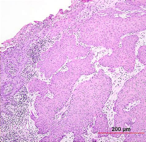 Pathology Outlines Squamous Cell Carcinoma Scc