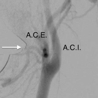 Arteriografia De Art Ria Car Tida Comum Esquerda E De Seus Ramos