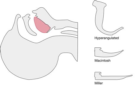 Differential Diagnosis of Technique for Video Laryngoscopy