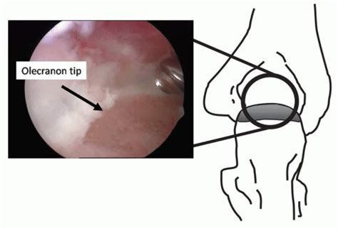 Valgus Extension Overload Musculoskeletal Key