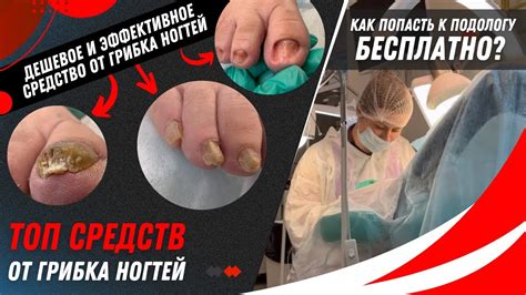 Топ средств от грибка ногтей. Дешевое и эффективное средство от грибка ...
