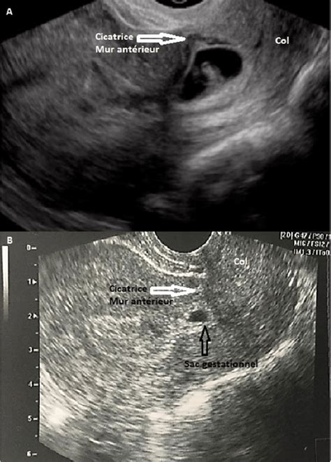 A Sagittal Cut Of A Pelvic Ultrasound Visualizing A Cesarean Scar