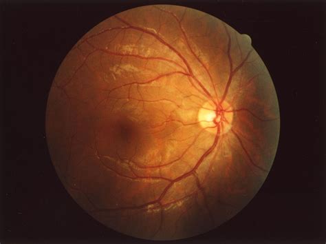 Fundus Eye Wikipedia